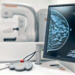 cancer sein dépistage imprimante 3d