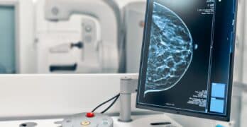 cancer sein dépistage imprimante 3d