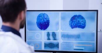 impression 3d cerveau